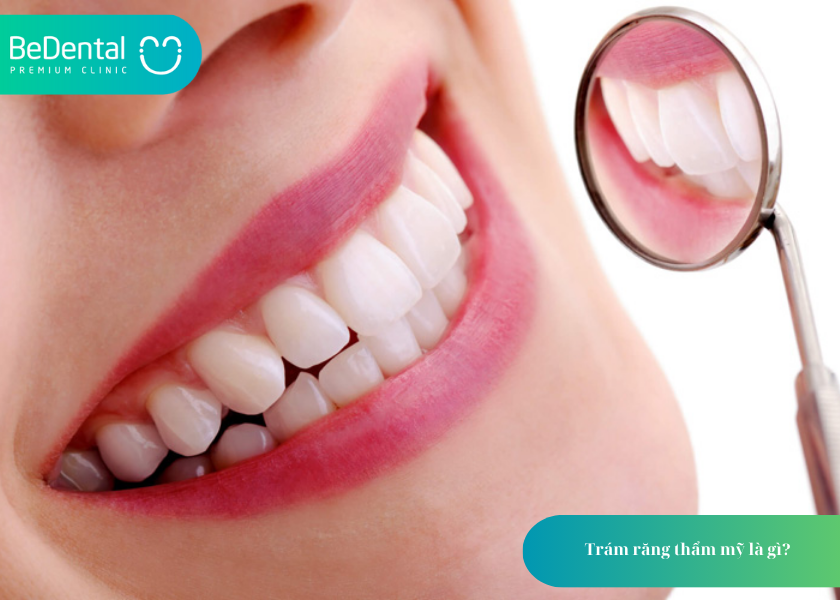 Trám răng thẩm mỹ là gì? và 4 điều cần biết 2 Trám răng thẩm mỹ là gì? Trám răng thẩm mỹ là gì?