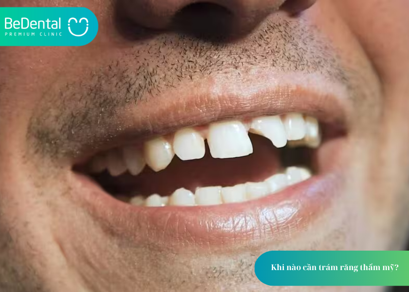 Trám răng thẩm mỹ là gì? và 4 điều cần biết 3 How much does teeth whitening cost 29 4