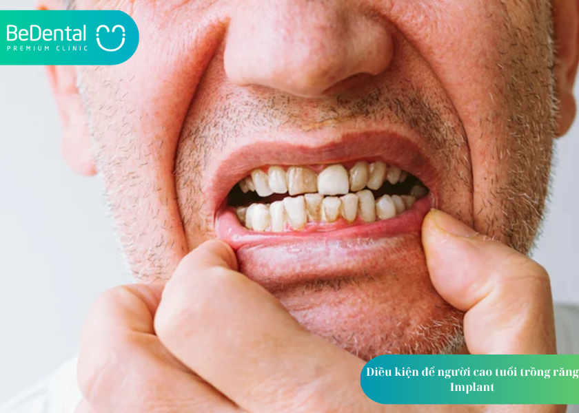 Trồng răng Implant cho người cao tuổi: Có nên không và cần lưu ý gì? 3 Trồng răng Implant cho người cao tuổi