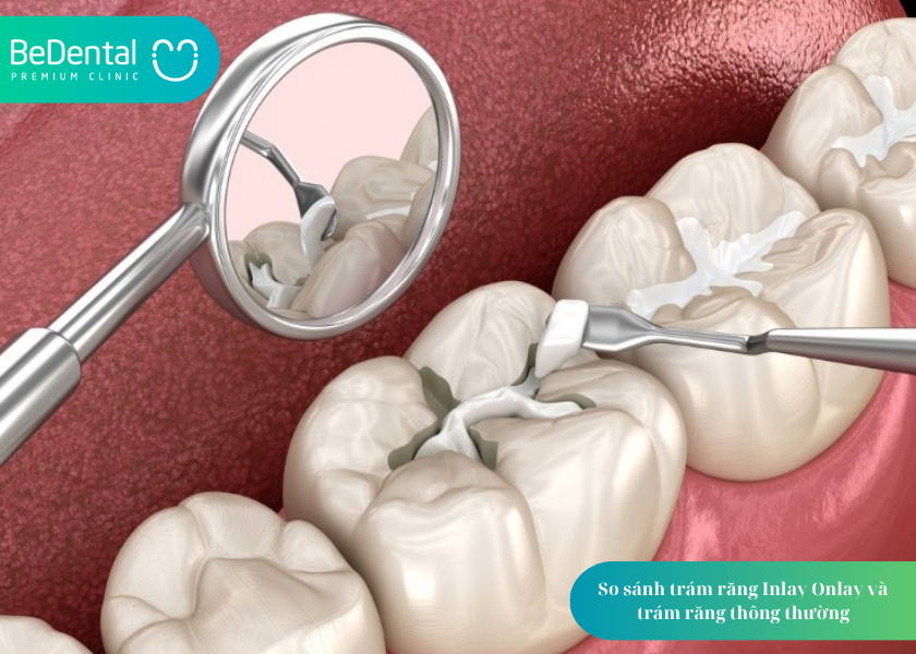 Trám Răng Inlay Onlay: Giải Pháp Phục Hình Hiện Đại, Bền Đẹp Cho Răng Sâu Nặng 3 How much does teeth whitening cost 3 7