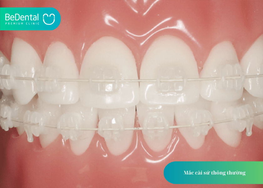Niềng răng mắc cài sứ: Giải pháp chỉnh nha thẩm mỹ, hiệu quả cho nụ cười tự tin 3 How much does teeth whitening cost 3 min 1