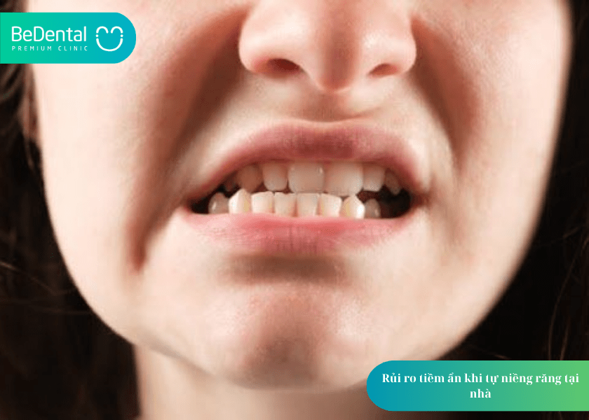 Niềng răng tại nhà: Giải pháp an toàn hay tiềm ẩn rủi ro? 3 How much does teeth whitening cost 3 min 11