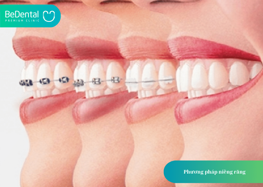 Niềng răng thưa 1 hàm giá bao nhiêu? Bảng giá chi tiết và lưu ý quan trọng 3 How much does teeth whitening cost 3 min 12
