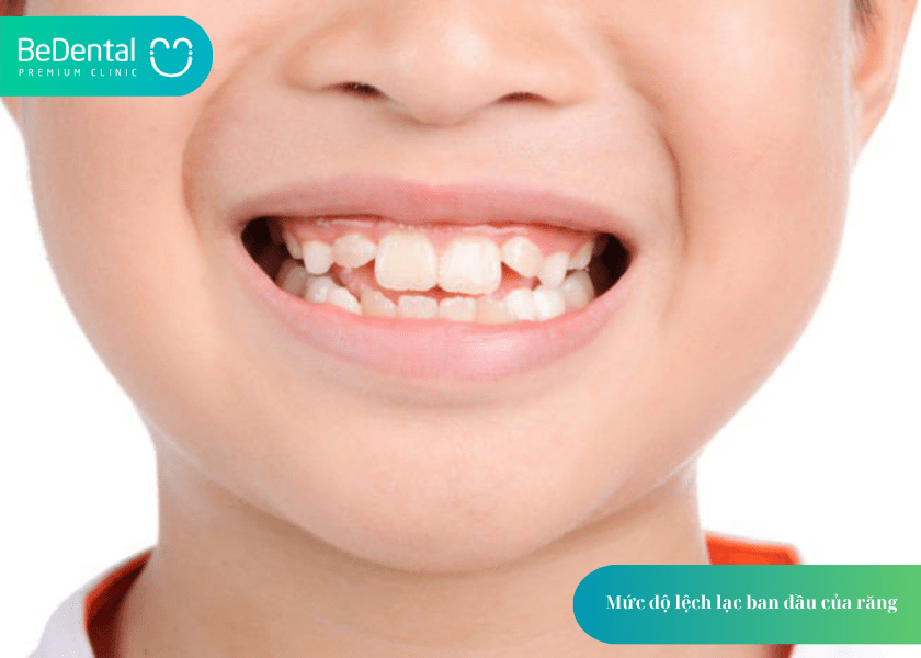 Đeo hàm duy trì trong bao lâu? Giải đáp chi tiết từ chuyên gia chỉnh nha 3 Đeo hàm duy trì trong bao lâu?