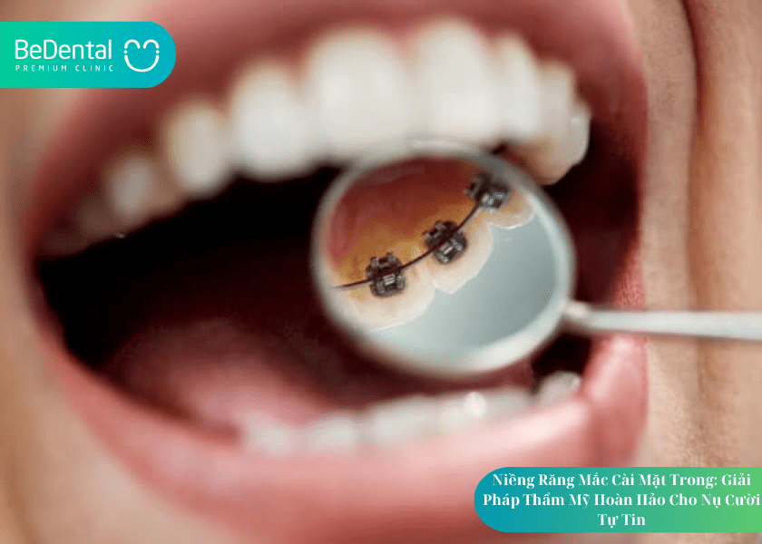 Niềng răng mắc cái mặt trong