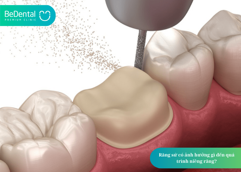 Răng sứ có niềng được không? Giải đáp chi tiết từ chuyên gia nha khoa 3 How much does teeth whitening cost 3 min 9