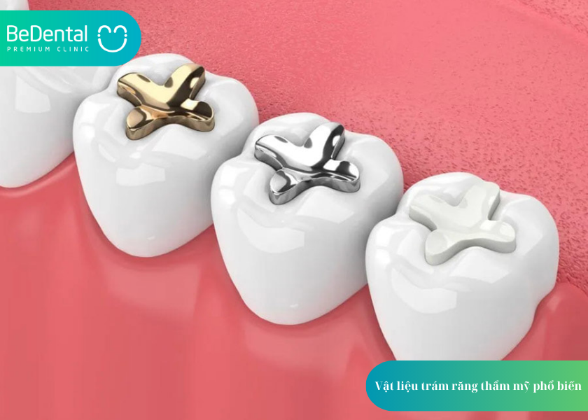 Trám răng thẩm mỹ là gì? và 4 điều cần biết 4 How much does teeth whitening cost 30 4
