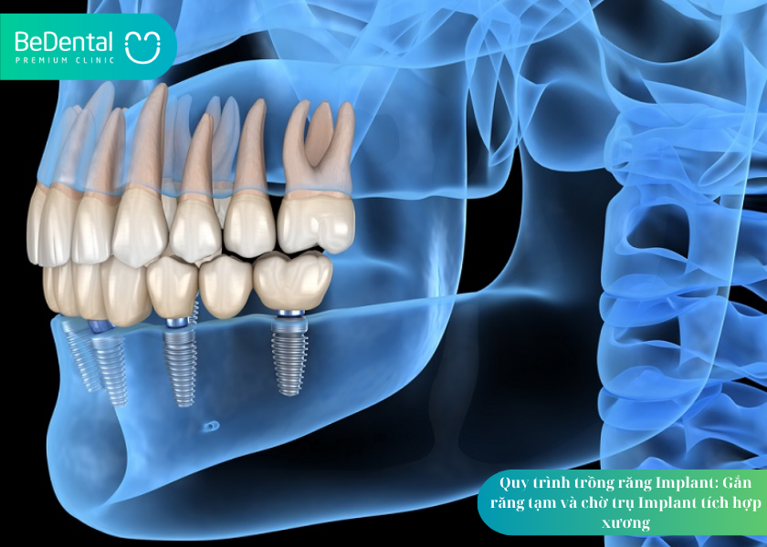Quy Trình Trồng Răng Implant: 5 Bước Thực Hiện Chi Tiết, An Toàn và Hiệu Quả 4 How much does teeth whitening cost 30