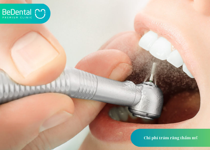 Trám răng thẩm mỹ là gì? và 4 điều cần biết 5 How much does teeth whitening cost 31 4