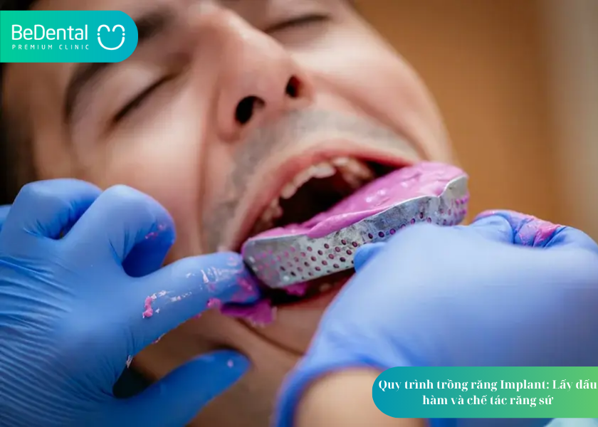 Quy Trình Trồng Răng Implant: 5 Bước Thực Hiện Chi Tiết, An Toàn và Hiệu Quả 5 How much does teeth whitening cost 31