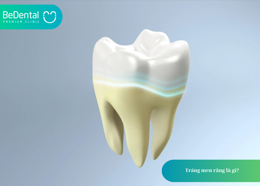 Tráng men răng: Giải pháp bảo vệ và làm đẹp răng toàn diện 2 Tráng men răng là gì?