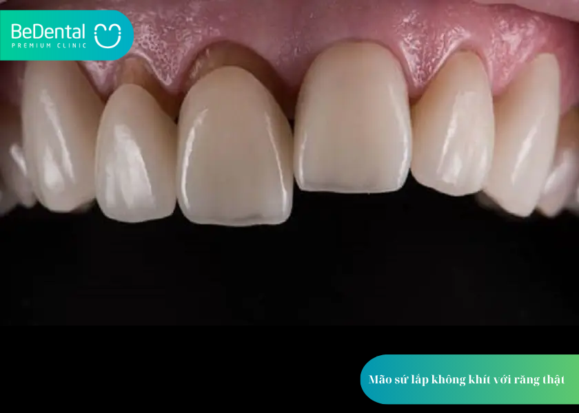 Bọc răng sứ bị nhức phải làm sao? 5 điều cần biết để xử lý đúng cách 2 Bọc răng sứ bị nhức phải làm sao?