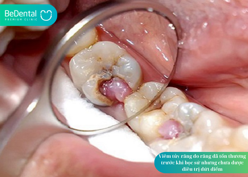 Bọc răng sứ bị nhức phải làm sao? 5 điều cần biết để xử lý đúng cách 3 How much does teeth whitening cost 35
