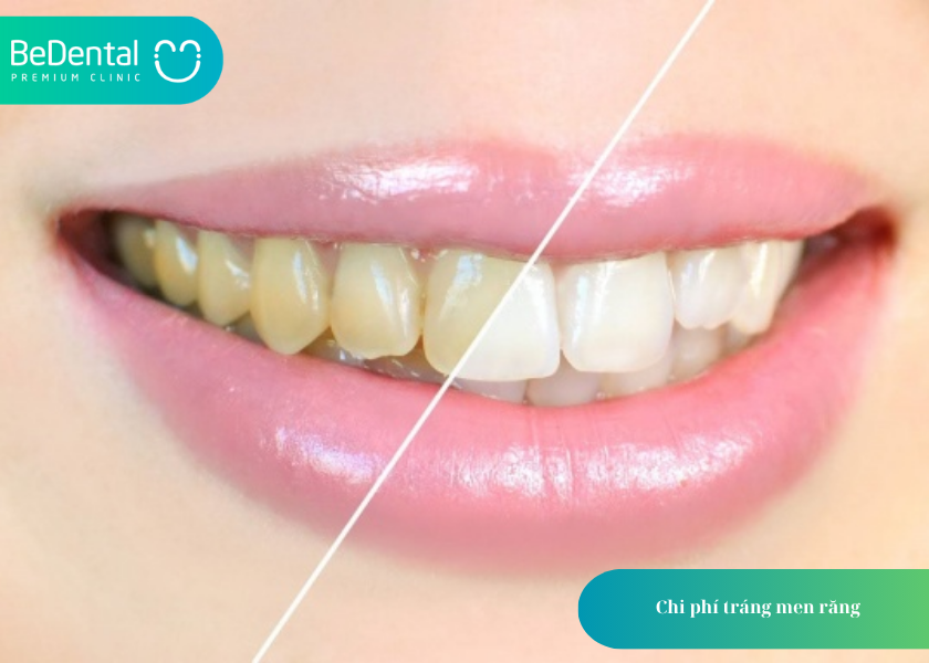Tráng men răng: Giải pháp bảo vệ và làm đẹp răng toàn diện 4 How much does teeth whitening cost 36 2