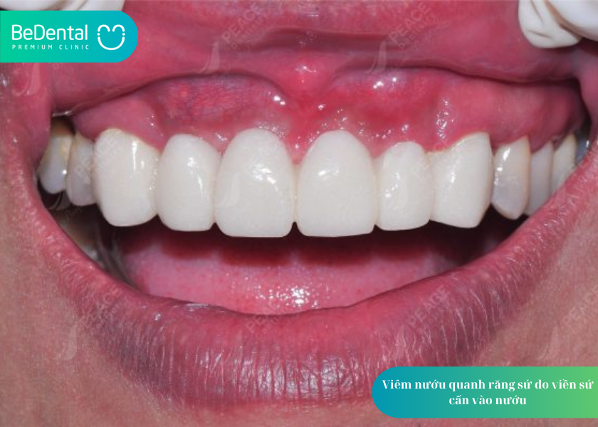 Bọc răng sứ bị nhức phải làm sao? 5 điều cần biết để xử lý đúng cách 4 How much does teeth whitening cost 36