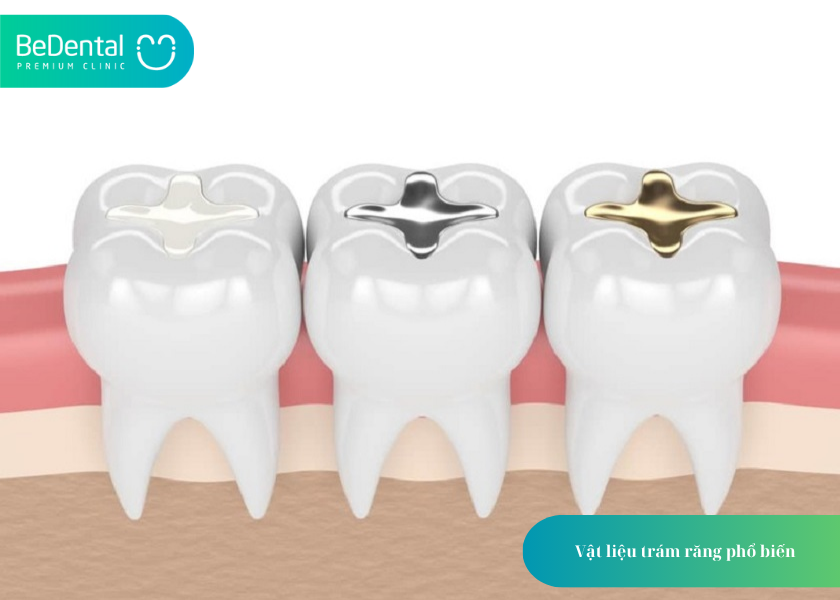 Trám Răng Sâu: Giải Pháp Hiệu Quả Bảo Tồn Răng Thật 3 How much does teeth whitening cost 39 1