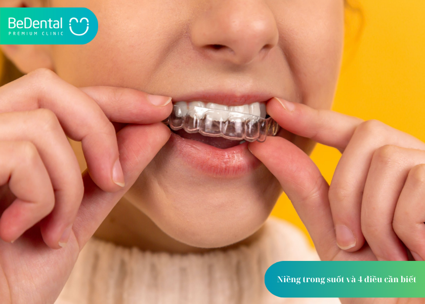 Niềng trong suốt và 4 điều cần biết