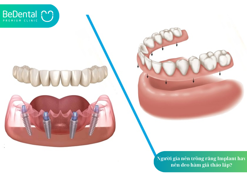 Trồng răng Implant cho người cao tuổi: Có nên không và cần lưu ý gì? 4 How much does teeth whitening cost 4 7