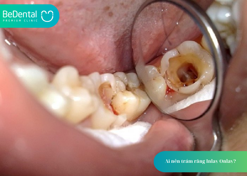Trám Răng Inlay Onlay: Giải Pháp Phục Hình Hiện Đại, Bền Đẹp Cho Răng Sâu Nặng 4 How much does teeth whitening cost 4 8