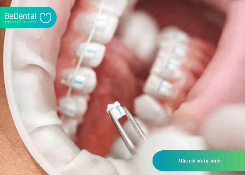 Niềng răng mắc cài sứ: Giải pháp chỉnh nha thẩm mỹ, hiệu quả cho nụ cười tự tin 4 How much does teeth whitening cost 4 min 1