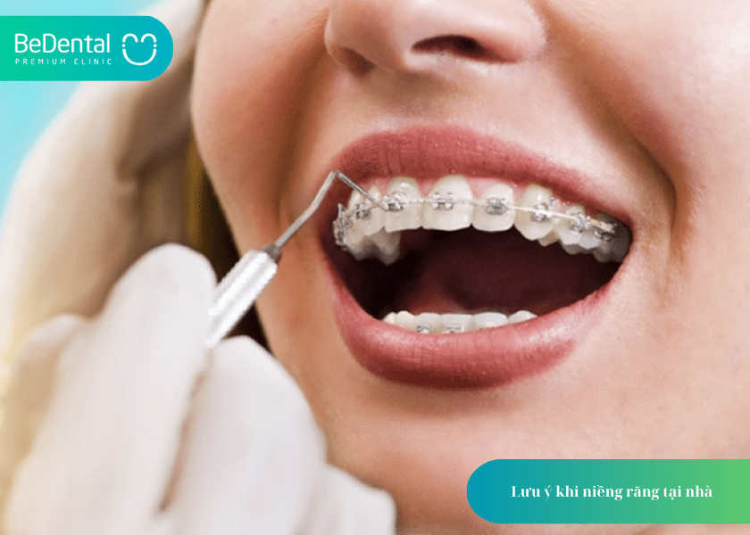 Niềng răng tại nhà: Giải pháp an toàn hay tiềm ẩn rủi ro? 4 How much does teeth whitening cost 4 min 11