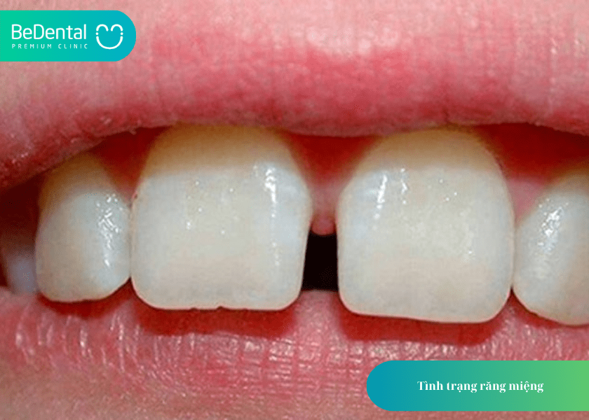 Niềng răng thưa 1 hàm giá bao nhiêu? Bảng giá chi tiết và lưu ý quan trọng 4 How much does teeth whitening cost 4 min 12