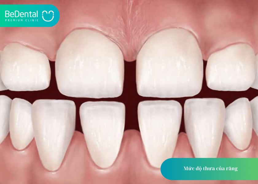 Niềng răng thưa mất bao lâu? Thời gian và 4 điều cần biết 4 How much does teeth whitening cost 4 min 13