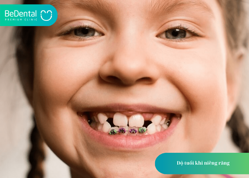 Đeo hàm duy trì trong bao lâu? Giải đáp chi tiết từ chuyên gia chỉnh nha 4 How much does teeth whitening cost 4 min 14