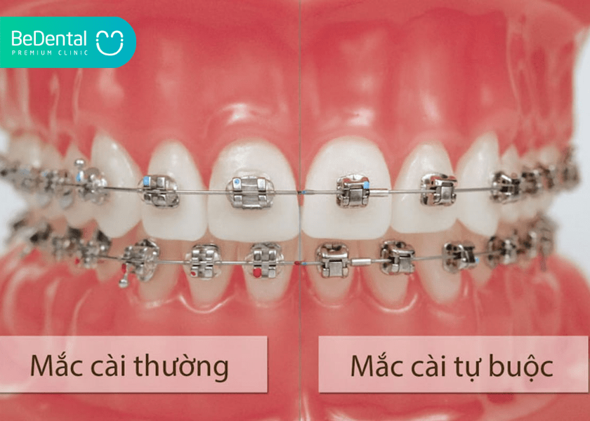 Mắc cài tự động: Giải pháp chỉnh nha tiên tiến giúp rút ngắn thời gian điều trị 3 How much does teeth whitening cost 4 min 2