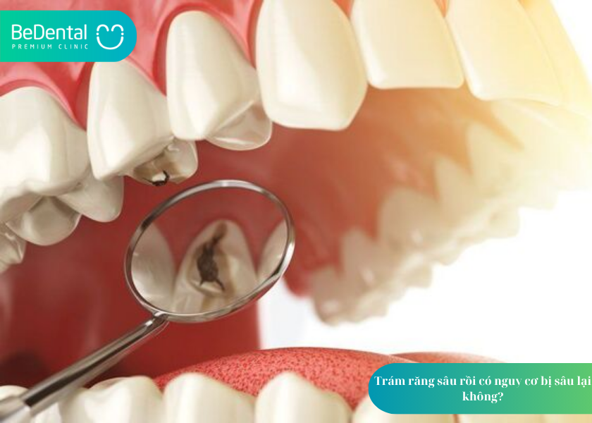 Trám Răng Sâu: Giải Pháp Hiệu Quả Bảo Tồn Răng Thật 4 Trám răng sâu rồi có nguy cơ bị sâu lại không?