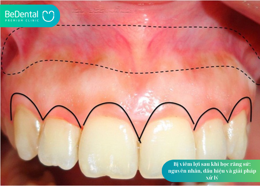 Bị viêm lợi sau khi bọc răng sứ. Bị viêm lợi sau khi bọc răng sứ
