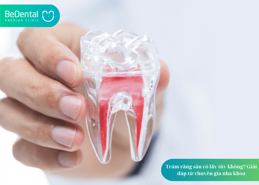 Trám răng sâu có lấy tủy không? Trám răng sâu có lấy tủy không?