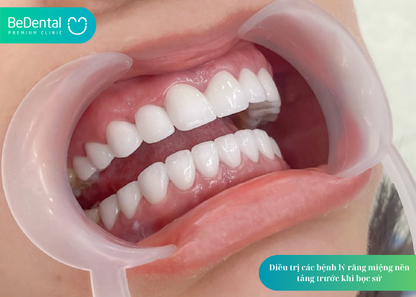 How much does teeth whitening cost 45