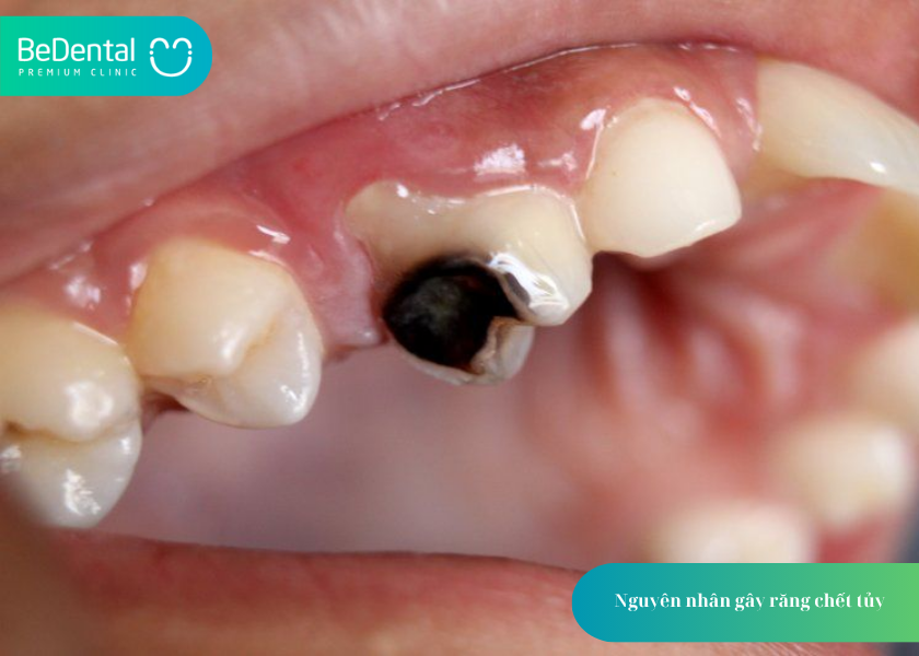 Răng Chết Tủy: Nguyên Nhân, Dấu Hiệu Và Cách Xử Lý Hiệu Quả 2 How much does teeth whitening cost 49