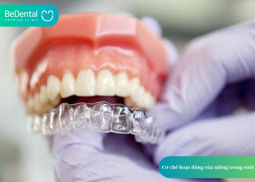 Niềng trong suốt và 4 điều cần biết 2 Niềng trong suốt và 4 điều cần biết