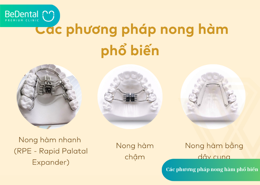Nong Hàm: Giải Pháp Mở Rộng Cung Hàm An Toàn, Hiệu Quả – Khách Hàng Cần Lưu Ý Gì? 3 How much does teeth whitening cost 5 2