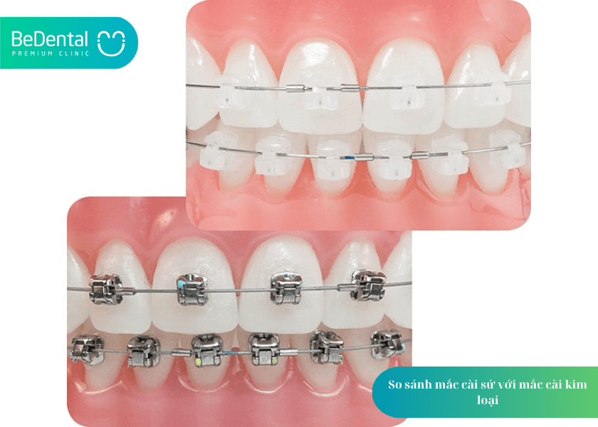 Niềng răng mắc cài sứ: Giải pháp chỉnh nha thẩm mỹ, hiệu quả cho nụ cười tự tin 5 How much does teeth whitening cost 5 min 1
