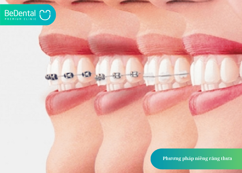 Niềng răng thưa mất bao lâu? Thời gian và 4 điều cần biết 5 How much does teeth whitening cost 5 min 11
