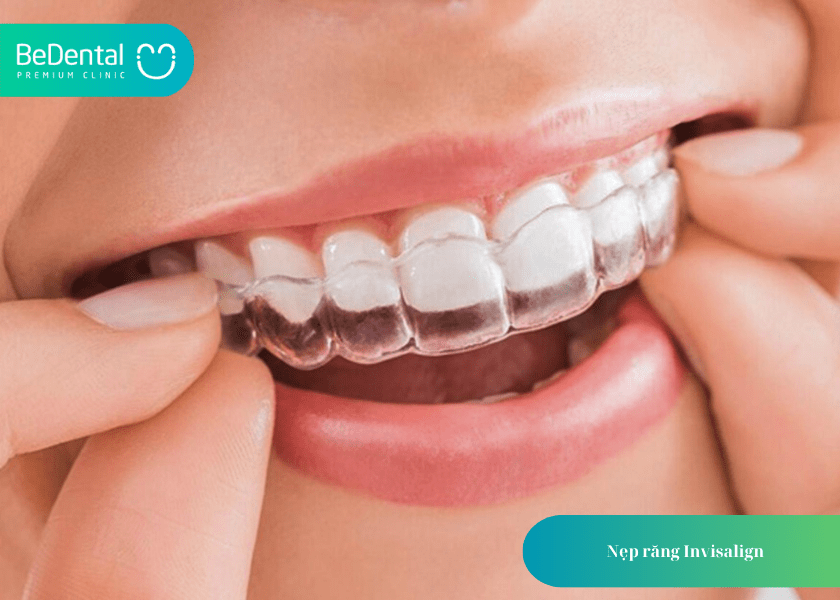 Nẹp răng nhựa và 4 điều cần biết 4 How much does teeth whitening cost 5 min 6