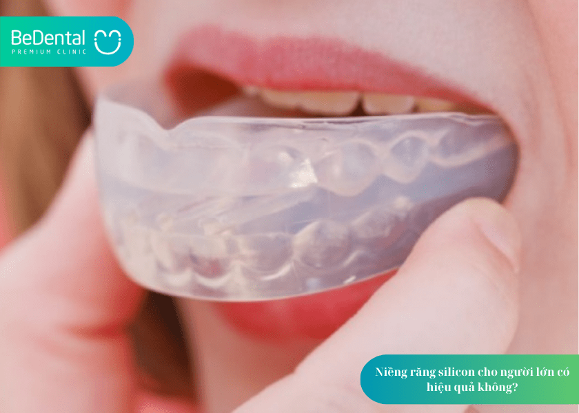 Niềng răng silicon và 4 điều bạn cần biết 5 How much does teeth whitening cost 5 min 7