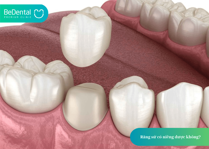 Răng sứ có niềng được không? Giải đáp chi tiết từ chuyên gia nha khoa 5 How much does teeth whitening cost 5 min 8