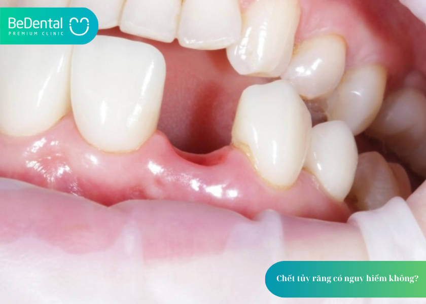 Răng Chết Tủy: Nguyên Nhân, Dấu Hiệu Và Cách Xử Lý Hiệu Quả 4 How much does teeth whitening cost 51