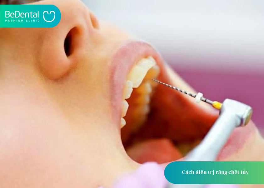 Răng Chết Tủy: Nguyên Nhân, Dấu Hiệu Và Cách Xử Lý Hiệu Quả 5 How much does teeth whitening cost 52