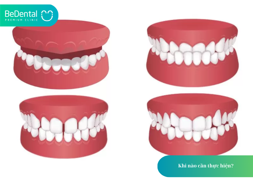 Nong Hàm: Giải Pháp Mở Rộng Cung Hàm An Toàn, Hiệu Quả – Khách Hàng Cần Lưu Ý Gì? 4 How much does teeth whitening cost 6 1