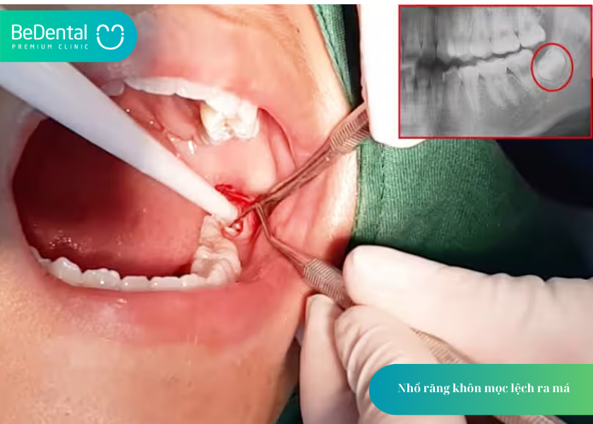 Răng Khôn Mọc Lệch Ra Má Hàm Trên: Tác Hại Và Cách Xử Lý 6 How much does teeth whitening cost 6 3