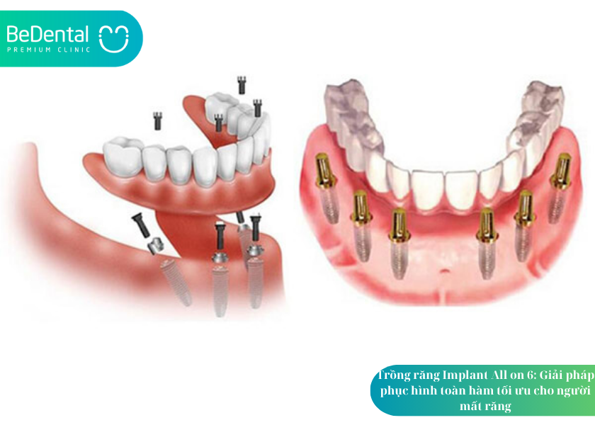 Trồng răng Implant All on 6