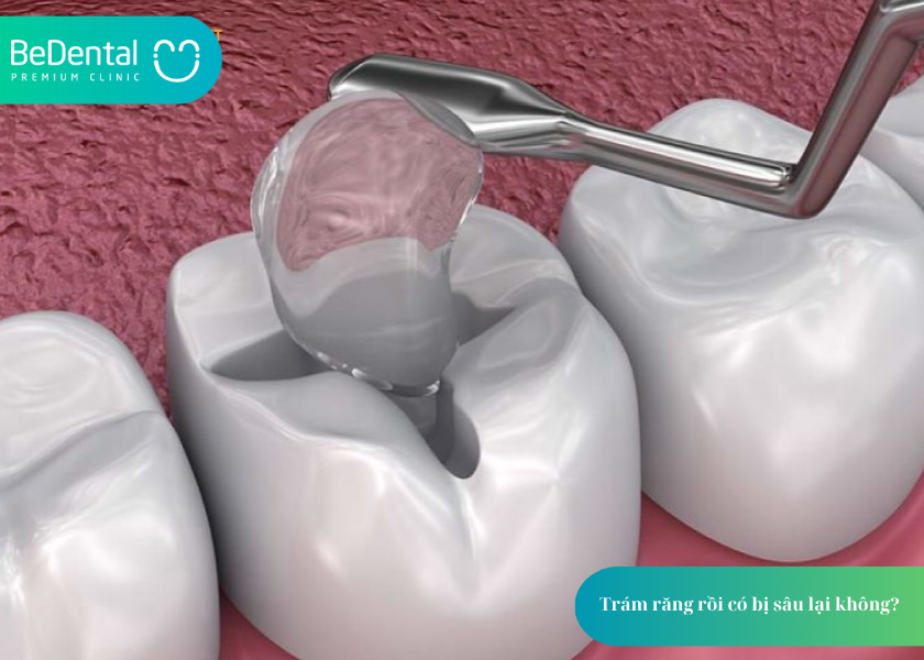Trám răng rồi có bị sâu lại không? Trám răng rồi có bị sâu lại không?