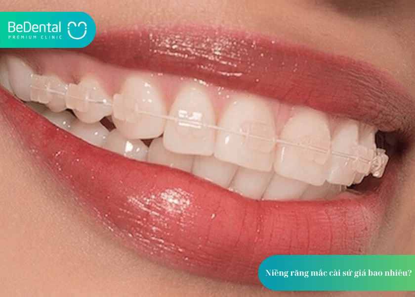 Niềng răng mắc cài sứ: Giải pháp chỉnh nha thẩm mỹ, hiệu quả cho nụ cười tự tin 6 How much does teeth whitening cost 6 min 1