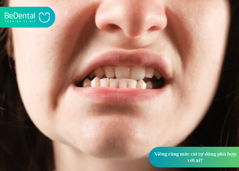 Mắc cài tự động: Giải pháp chỉnh nha tiên tiến giúp rút ngắn thời gian điều trị 5 How much does teeth whitening cost 6 min 2