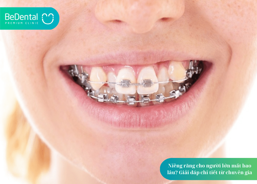 Niềng răng cho người lớn mất bao lâu?